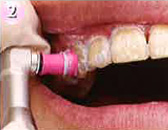 2.歯面の清掃